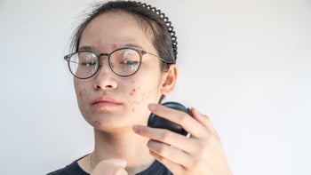 accutane: checking acne in mirror 1788422861