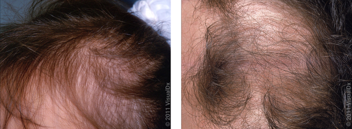 Left: Close up of side of head with decreased hair density in telogen effluvium. Right: Close up of the front of the scalp with significant hair loss in telogen effluvium.