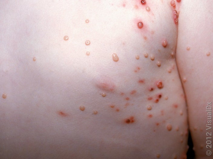 Some molluscum contagiosum bumps starting to get red, irritated, and crusty. 