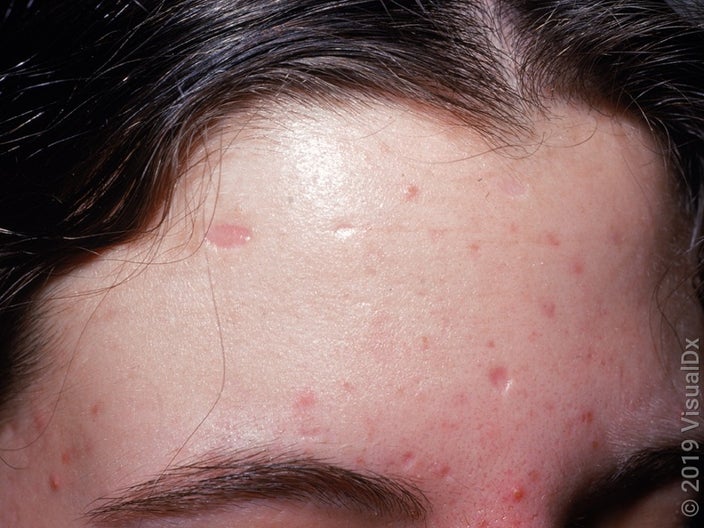 Close-up of the forehead with many depressed chickenpox scars. 