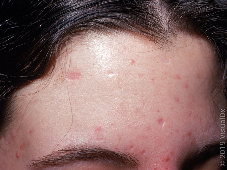 8 Ways to Get Rid of Chickenpox Scars - GoodRx