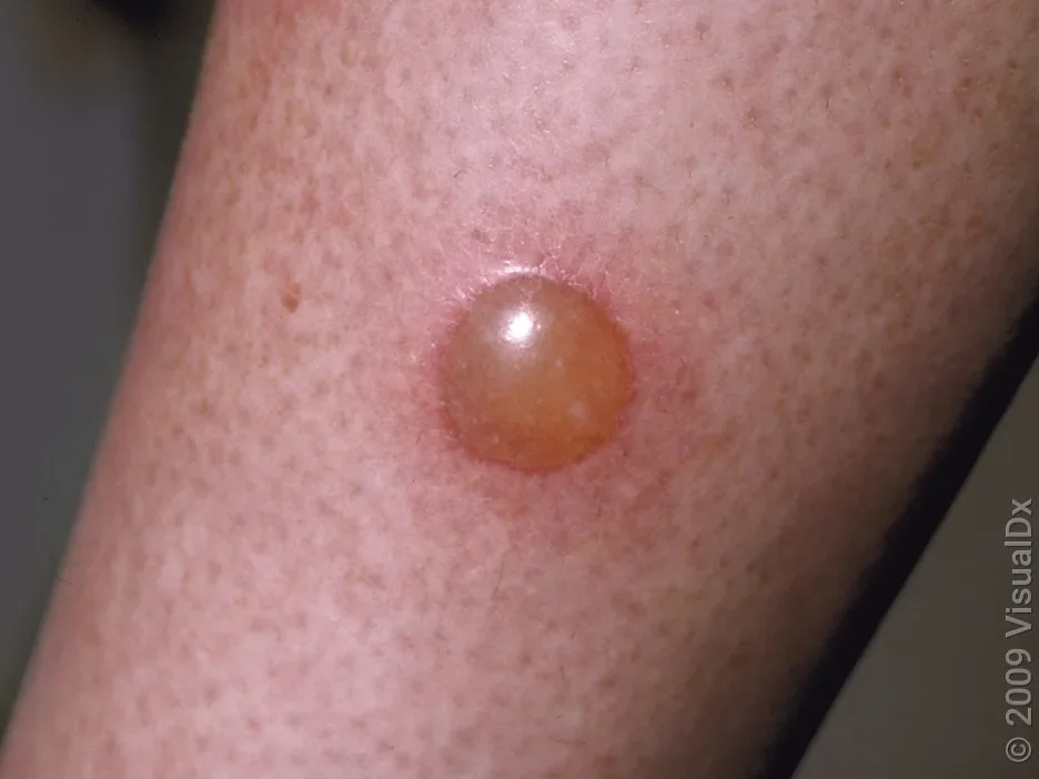 Close-up of an insect bite that formed a blister.