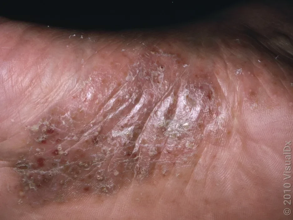 Close-up of pustular psoriasis on the sole of the foot.