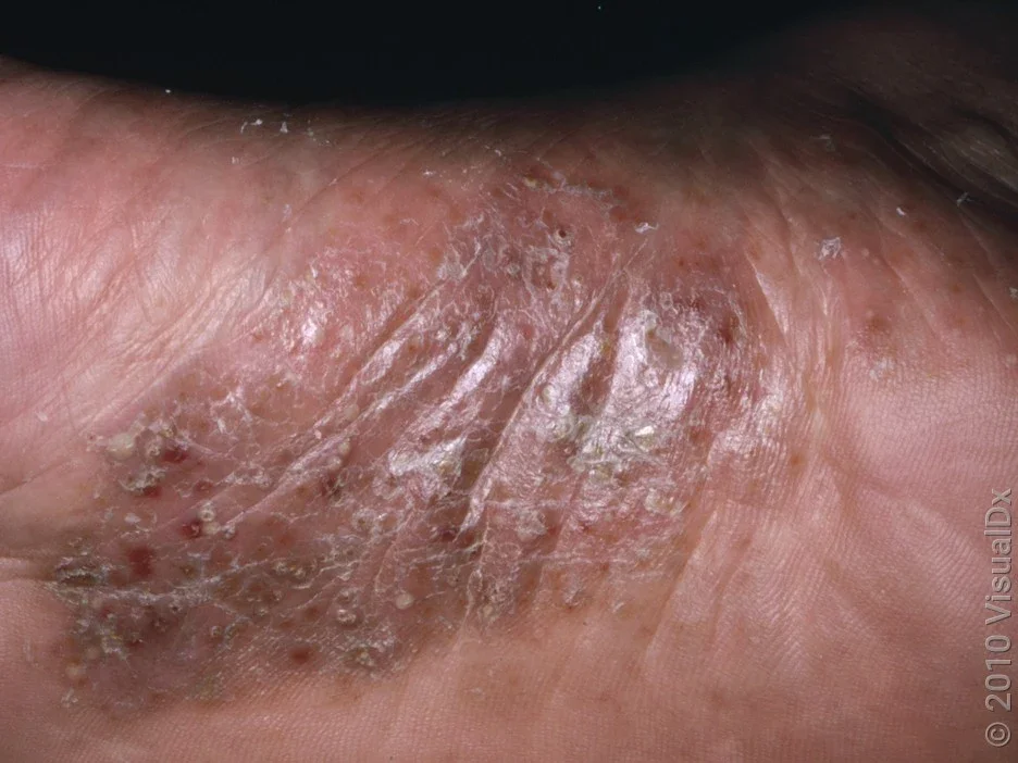 Close-up of pustular psoriasis on the sole of the foot. 