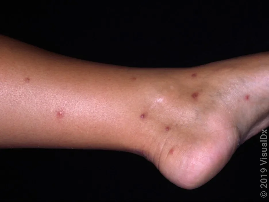 Small violet bug bites on the leg.