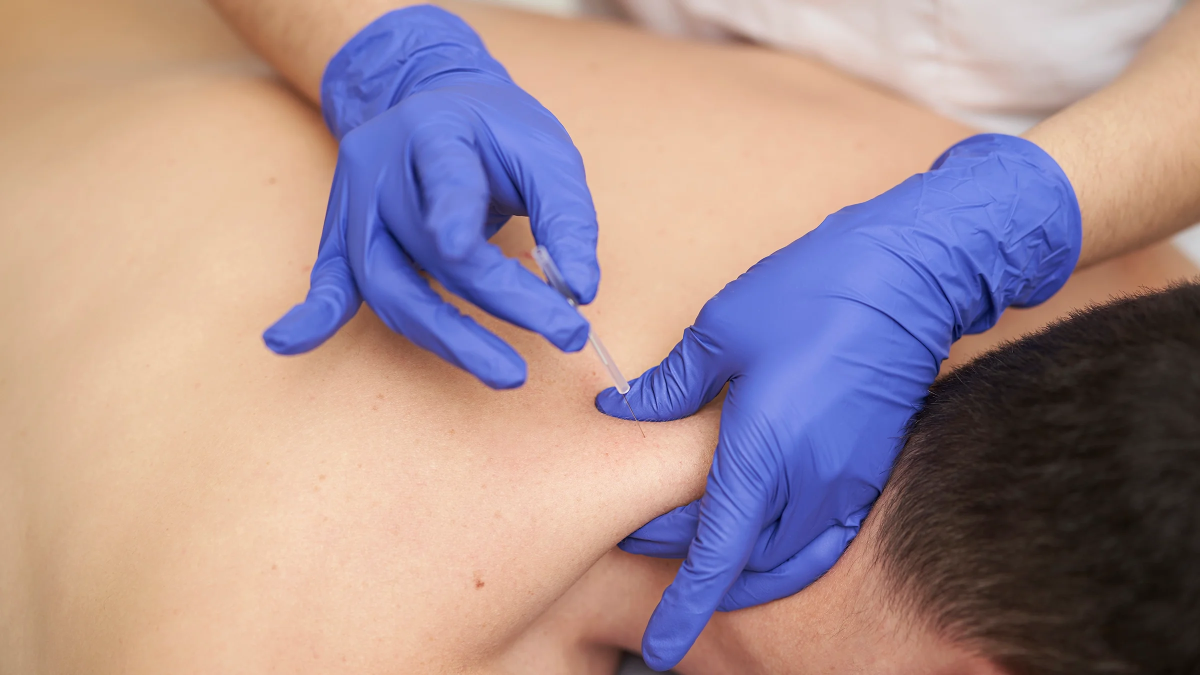 Close-up on a physical therapist using dry needling to treat a person’s neck.