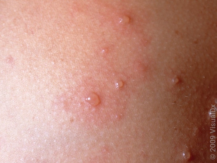 Close-up of chickenpox blisters.