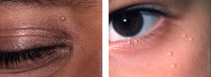 Left: A tiny, smooth, tan-white bump above the upper eyelid. Right: Four tiny, smooth bumps on the cheek below the eye. 