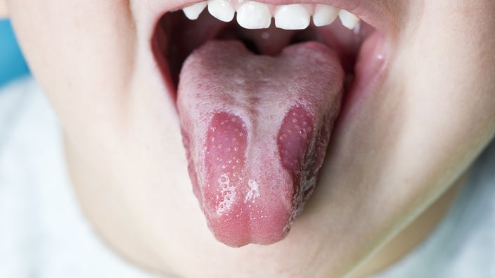 A close-up image shows a child with geographic tongue disease.