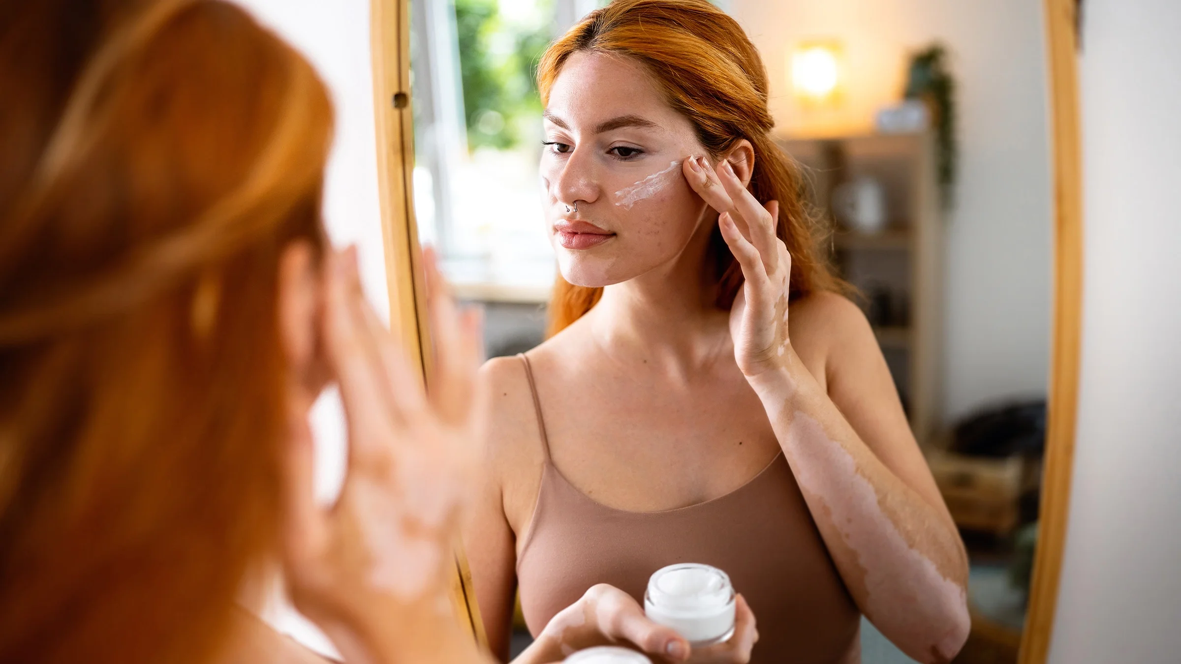 A woman with acne applies cream to her face.