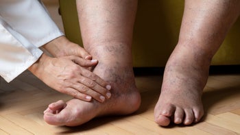 Musculoskeletal: closeup doctor examining feet 1135588159