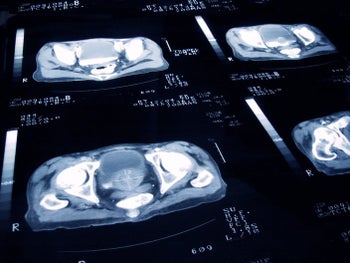 Health: Biopsy: GettyImages-1152162248