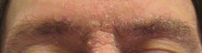 Red and flaky eyebrows caused by dandruff. 