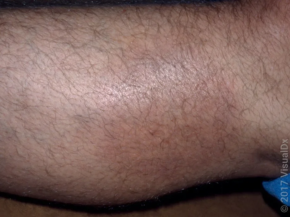 Close-up of a leg with Lyme disease, with a faint brown and pink round patch.