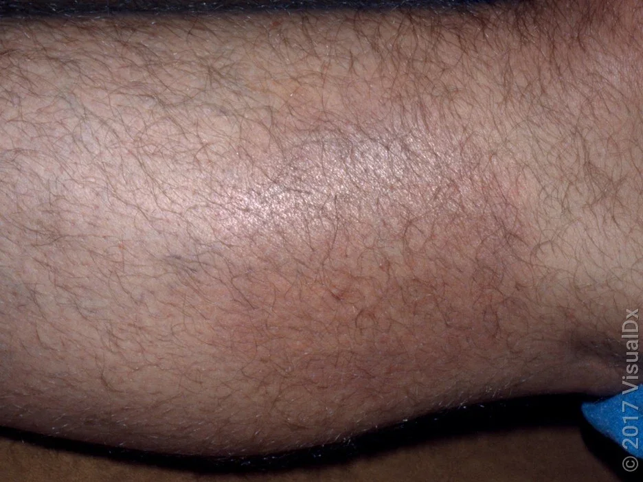 Close-up of a leg with Lyme disease, with a faint brown and pink round patch.