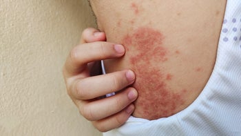 eczema: closeup eczema 2168564536