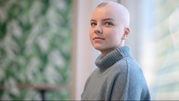 Health: Olumiant: portrait young woman alopecia patient 1142714317