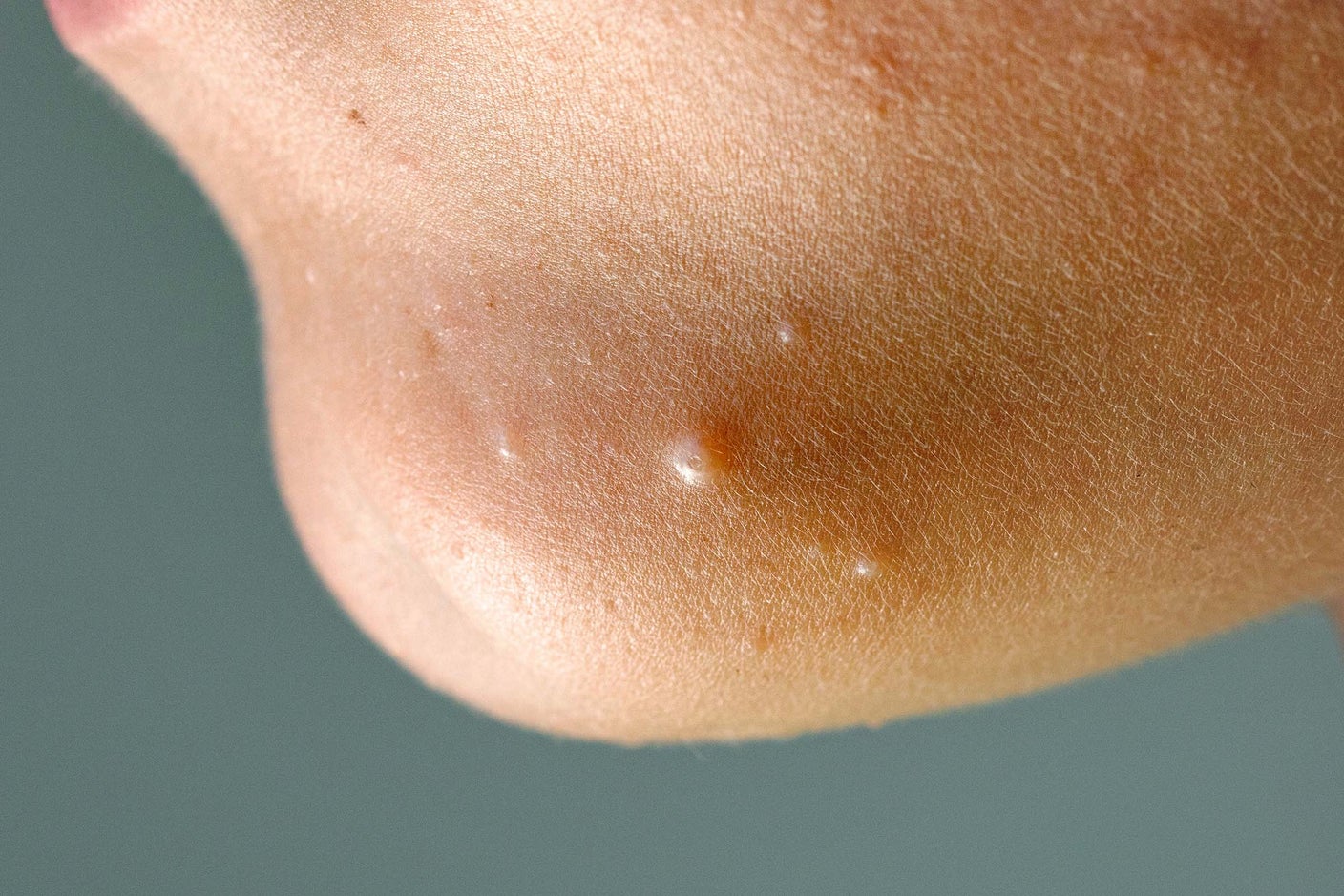 What Is Molluscum Contagiosum? Pictures, Causes, and Treatment GoodRx