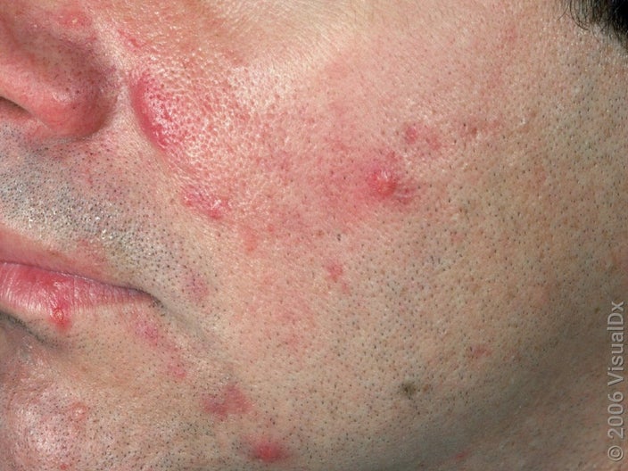 A large, smooth red skin bump (acne nodule) near the nose mixed with smaller red bumps on the side of the face. 