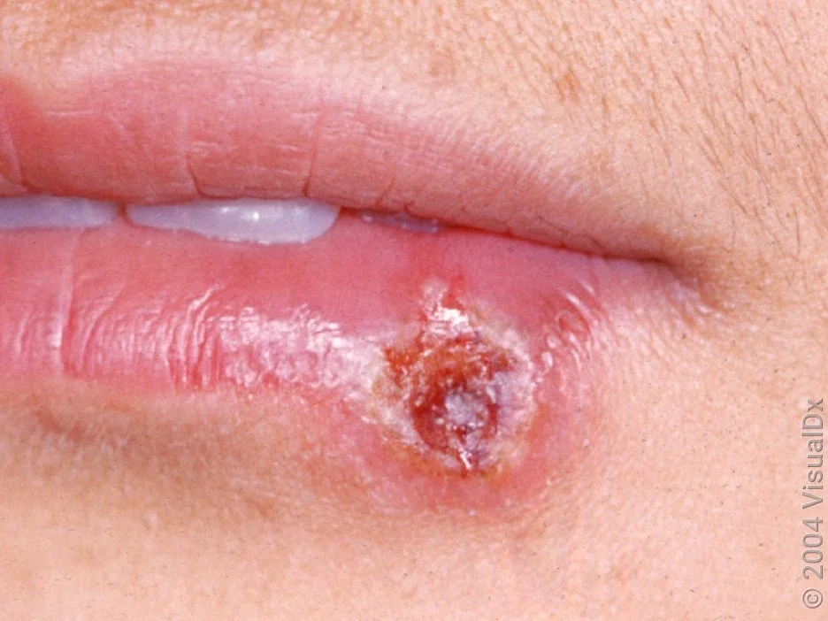 Close-up of a herpes cold sore on the lower lip. 