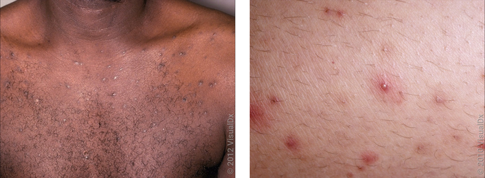 Left: Many small, brown skin bumps around hair follicles on the chest. Right: A close-up of pink bumps and pus-bumps around hair follicles. 