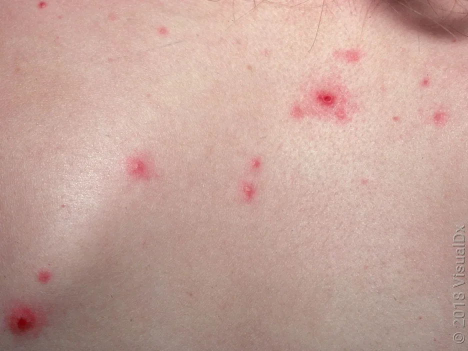 Chickenpox picture of early stages of chickenpox in fair skin.