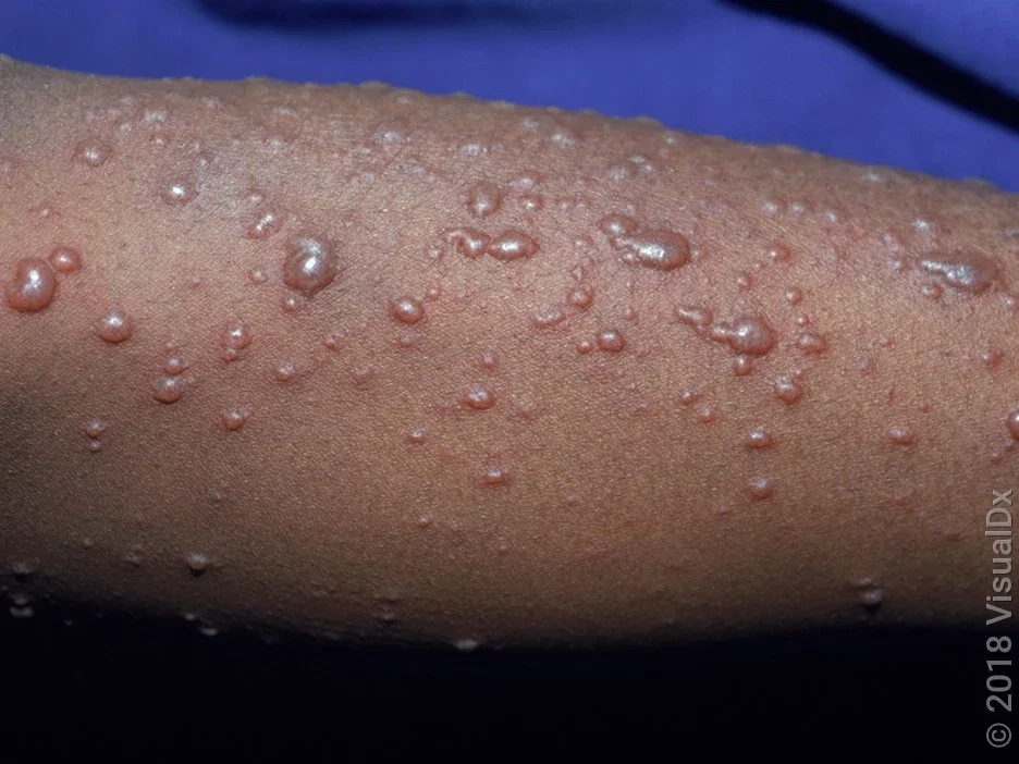 A close-up look at chickenpox blisters on darker skin. 