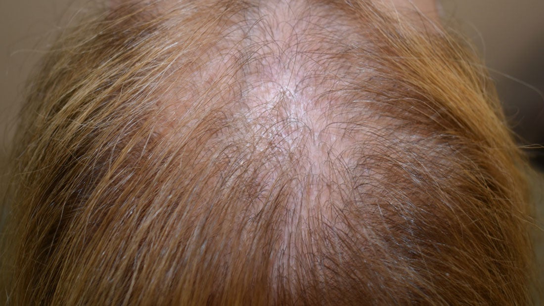 Female Pattern Hair Loss FPHL  Veritas Medical Aesthetics Clinic