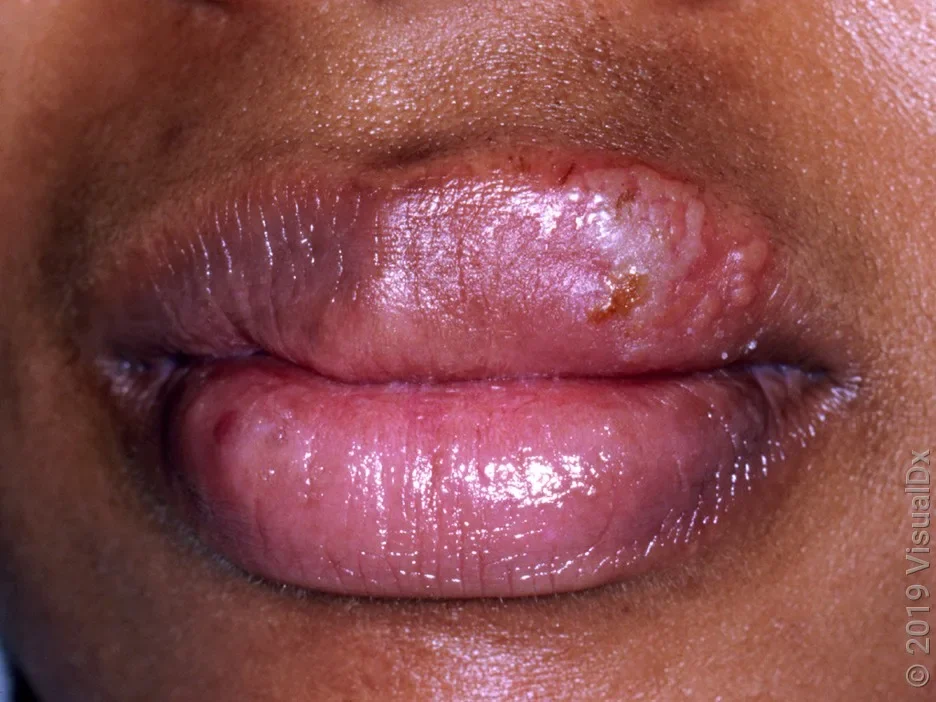 Close-up of a cold sore (herpes) on the lip.