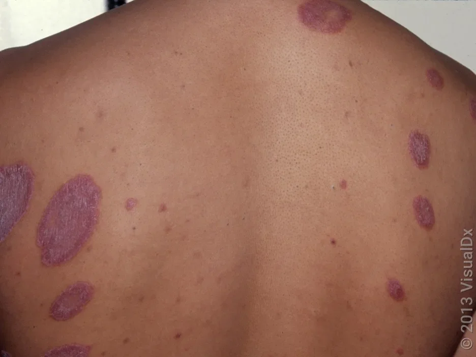 Close-up of the back with several violet, scaly patches in psoriasis.