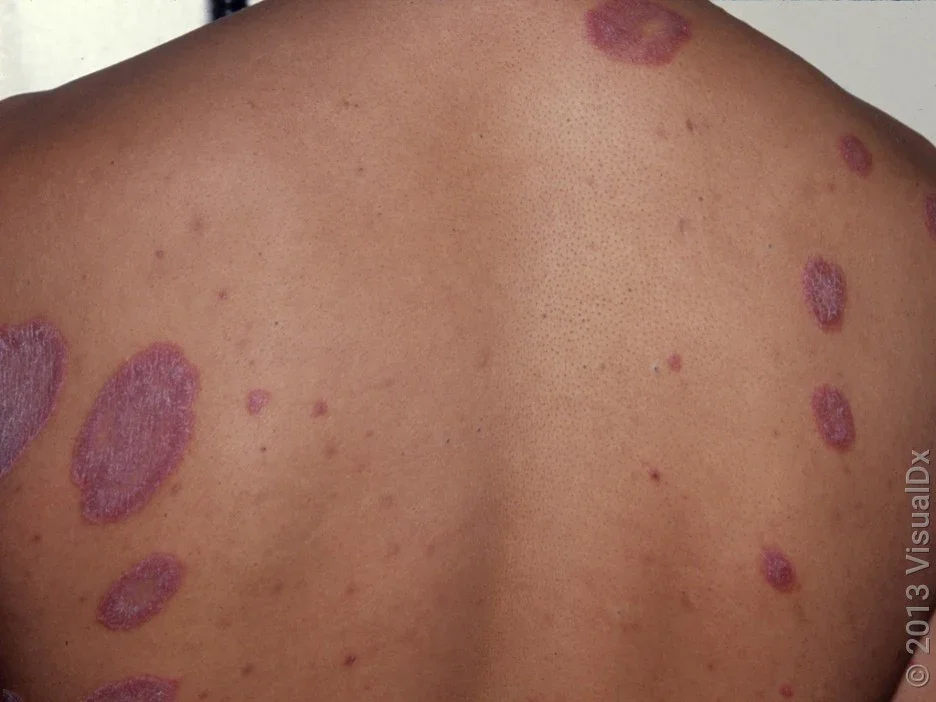 Close-up of the back with several violet, scaly patches in psoriasis.