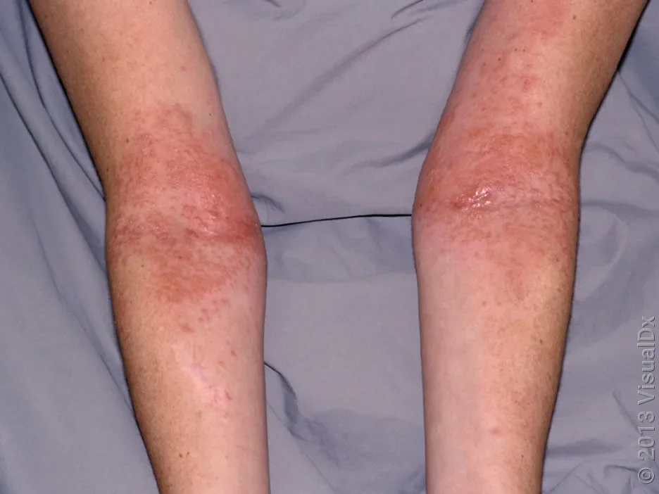 Close-up of skin in front of elbows with large pink patches.