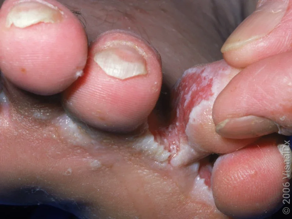 Severe athlete’s foot can cause open sores between the toes. 