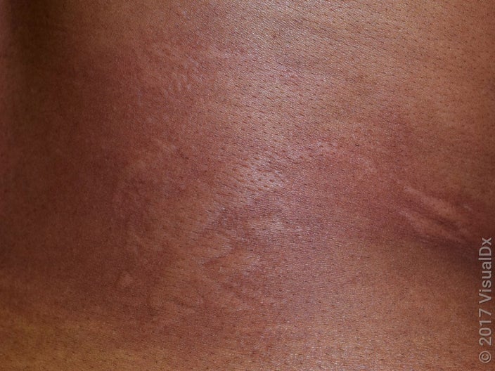 Hives in darker skin may be harder to see. 