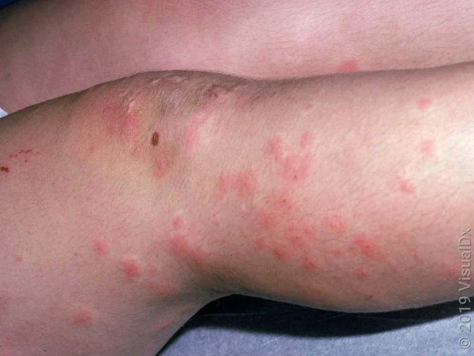 Close-up of swimmer’s itch and crusts on the legs.