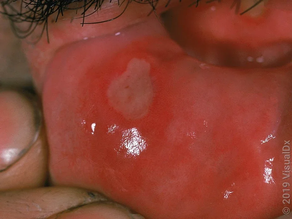 Close-up of canker sore on the inner lip.
