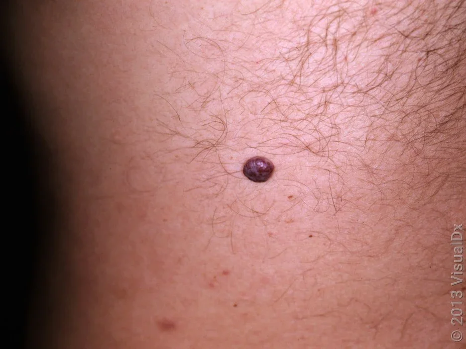 Close-up of a cherry angioma (blood mole).