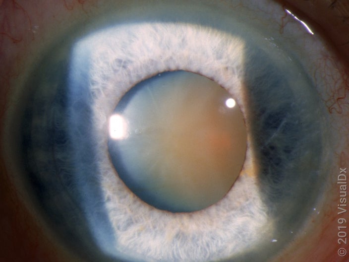 Dilated pupil with mature, cloudy cataract, as seen during an eye exam. 