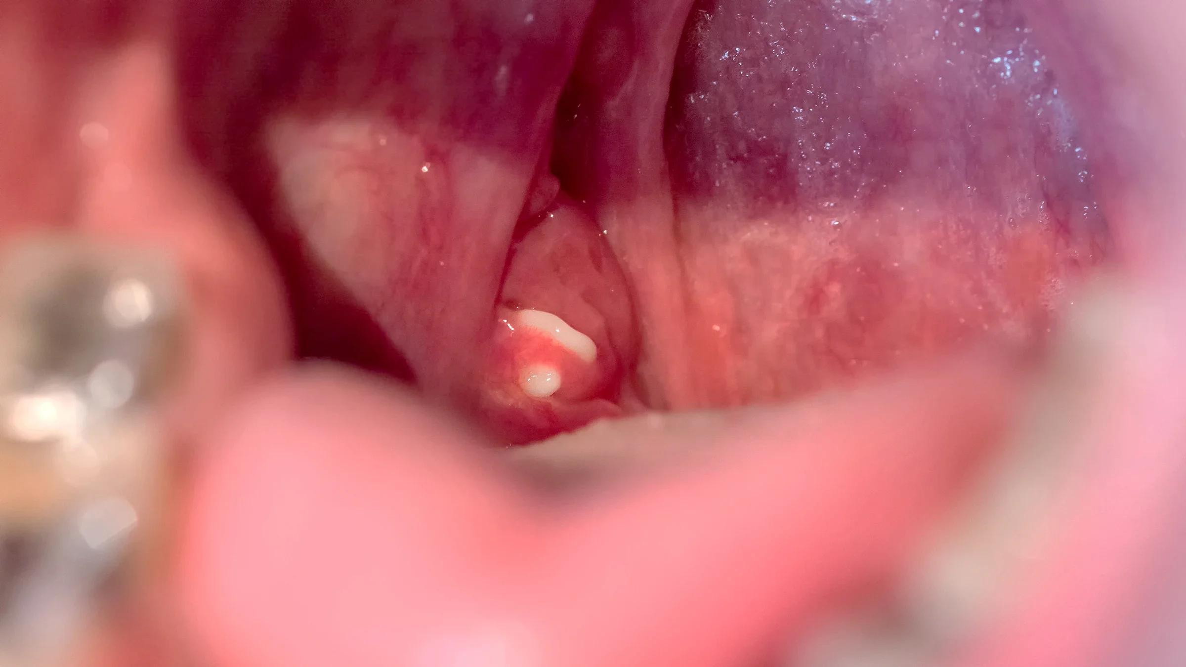 Extreme close-up of a person’s tonsils with white buildup deposits.