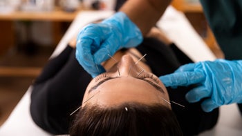 Health: Migraine: woman acupuncture therapy 1364149712