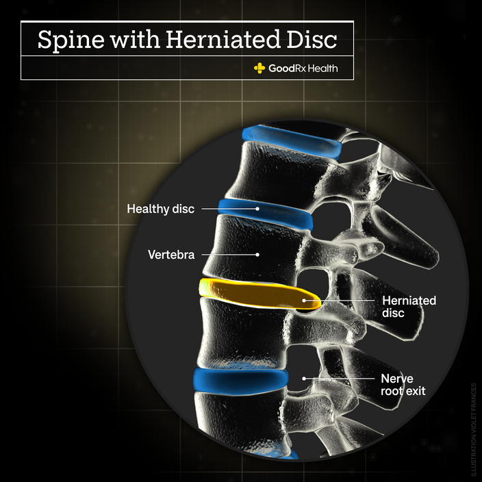 A 3D illustration of a spine with a herniated disc including healthy disc, vertebra, herniated disc, and nerve root exit.