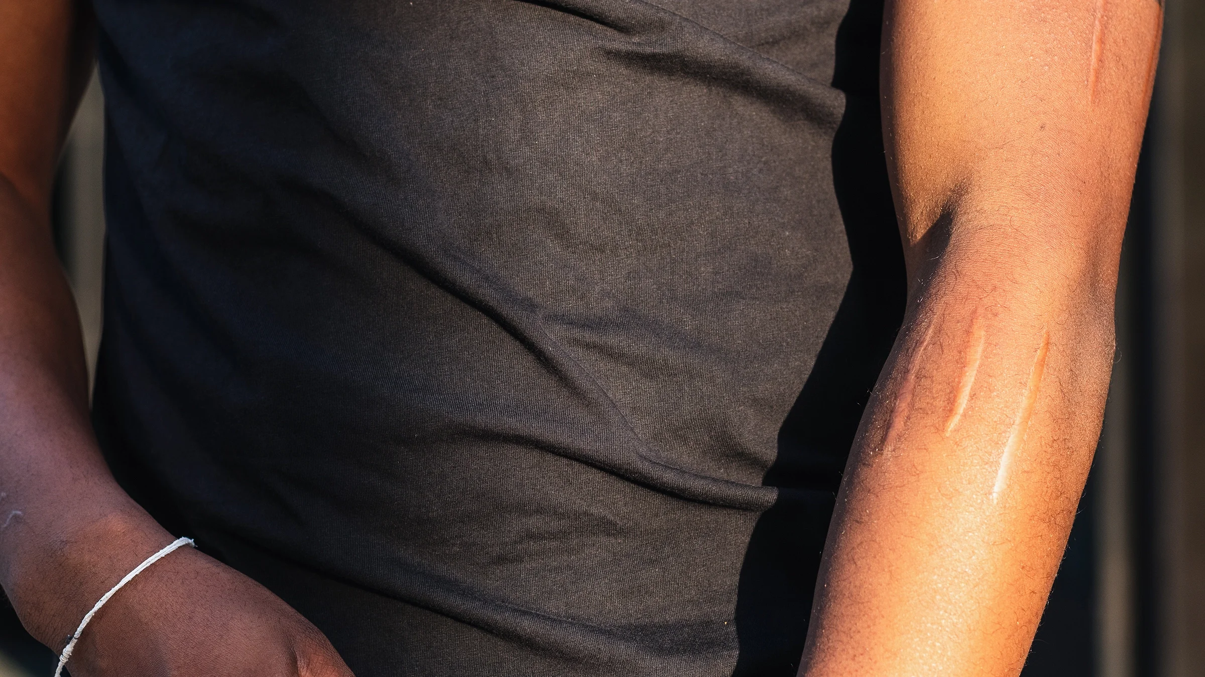 Close-up of a man with scars on his arm