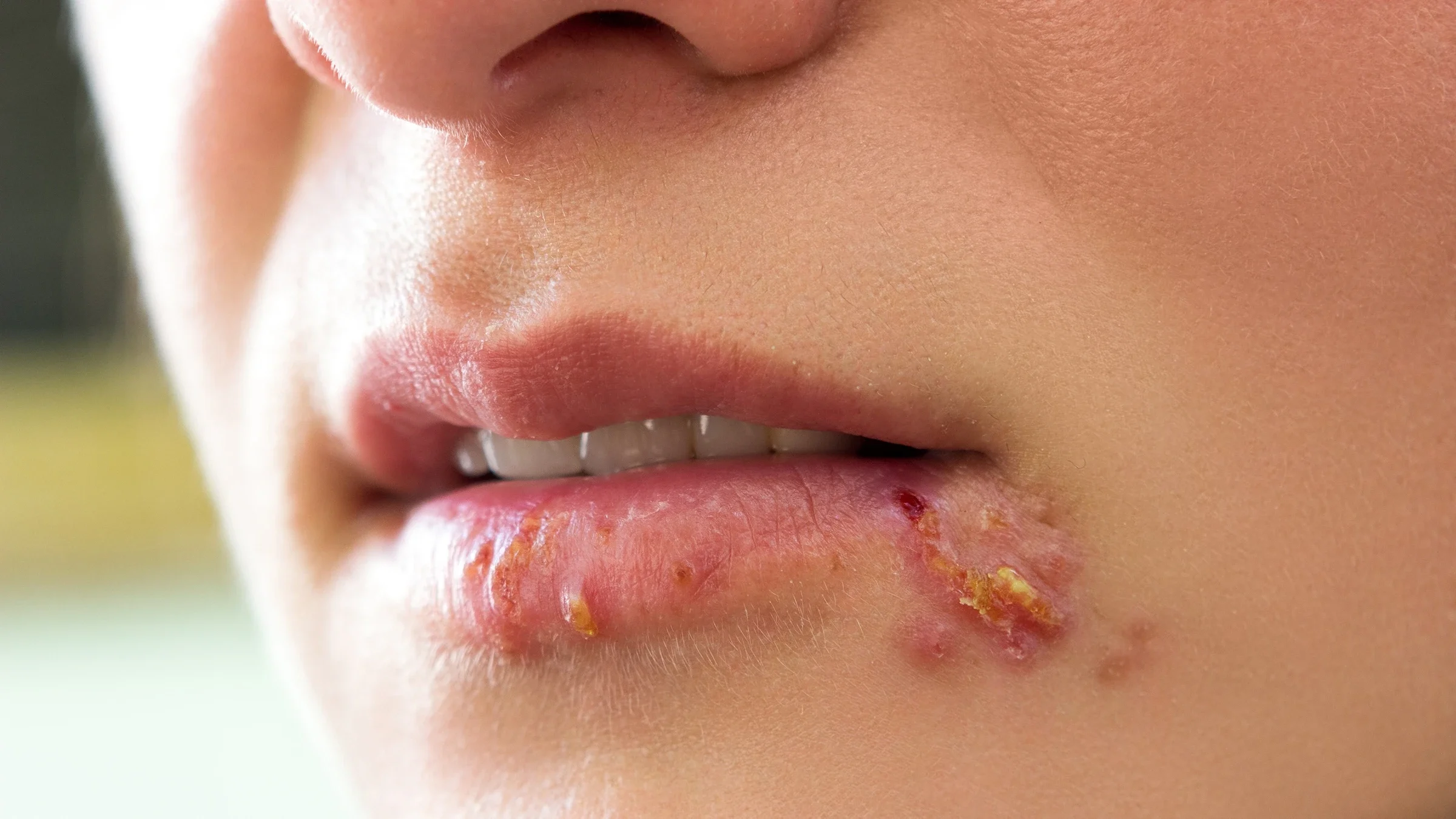 A close-up look of herpes blisters on the mouth.