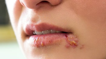 Herpes: closeup herpes blisters mouth 639695940