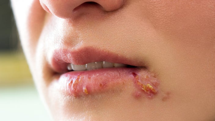 A close-up look of herpes blisters on the mouth.