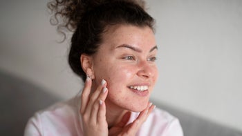 Dermatology: portrait of woman with acne 1472343555