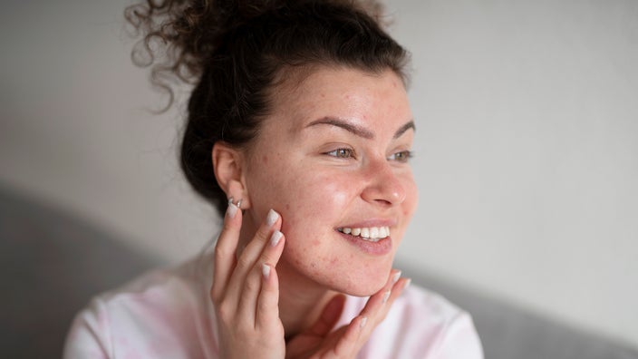 A portrait of a woman with acne.