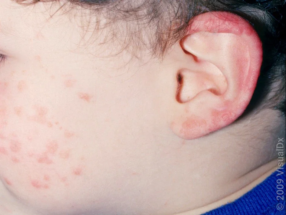 11 Common Rashes on Kids and Preschoolers (With Images) - GoodRx