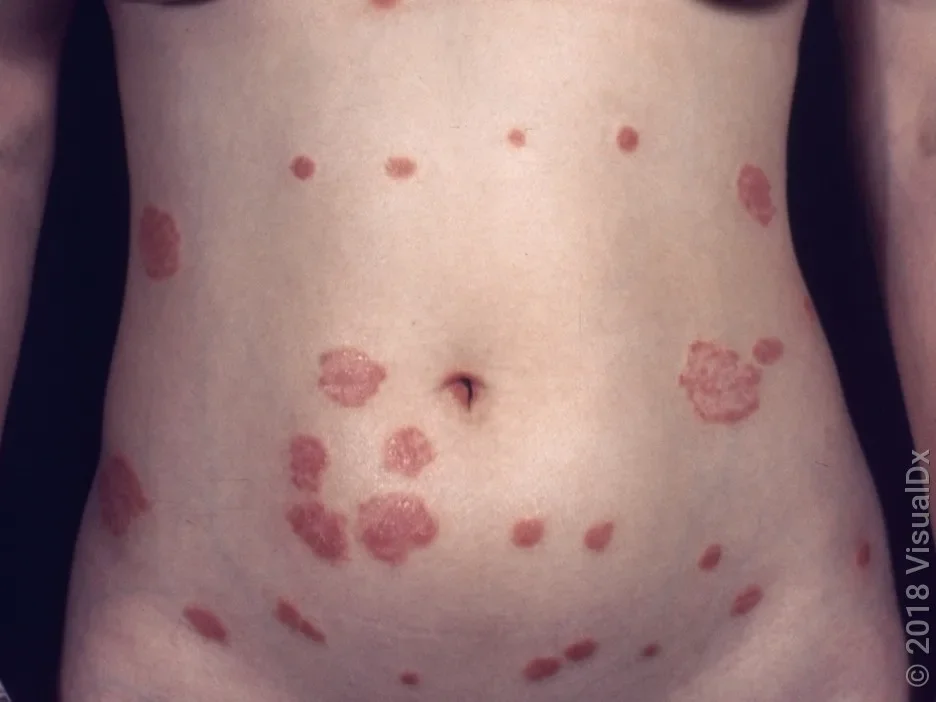 Close-up of an abdomen with many red, slightly scaly patches in plaque psoriasis.