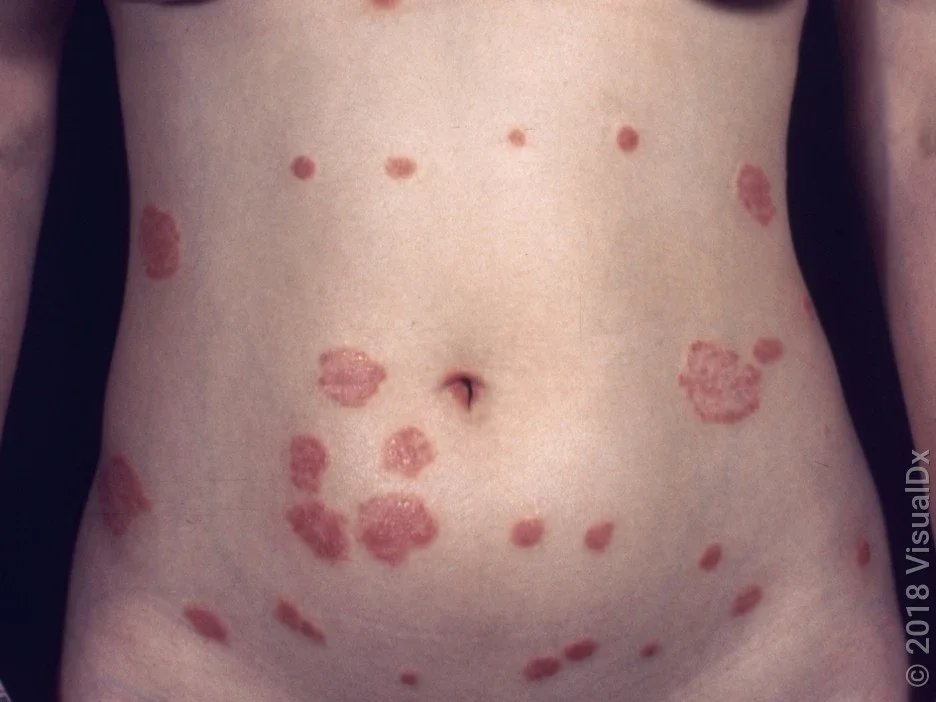 Close-up of an abdomen with many red, slightly scaly patches in plaque psoriasis. 